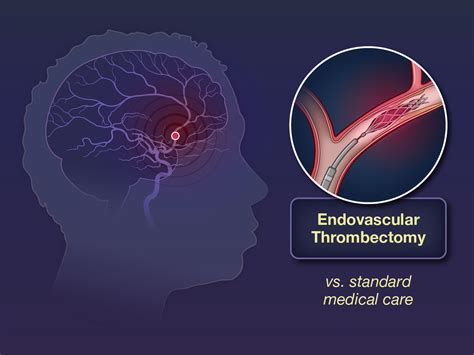 thrombectomy after ischaemic stroke